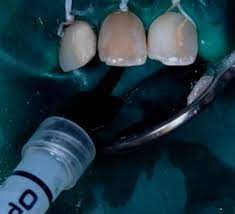 Prosedur tindakan bleaching gigi